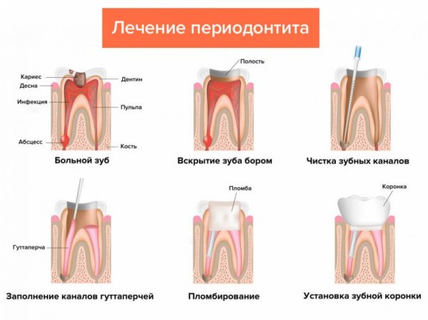 Лечение запущенного периодонтита