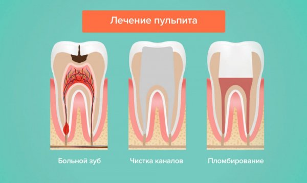 Пульпит лечение