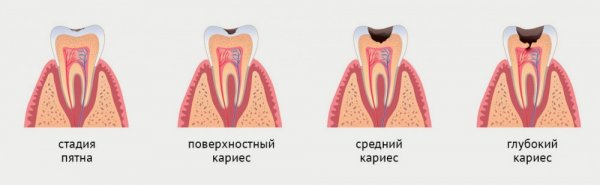 лечение кариеса